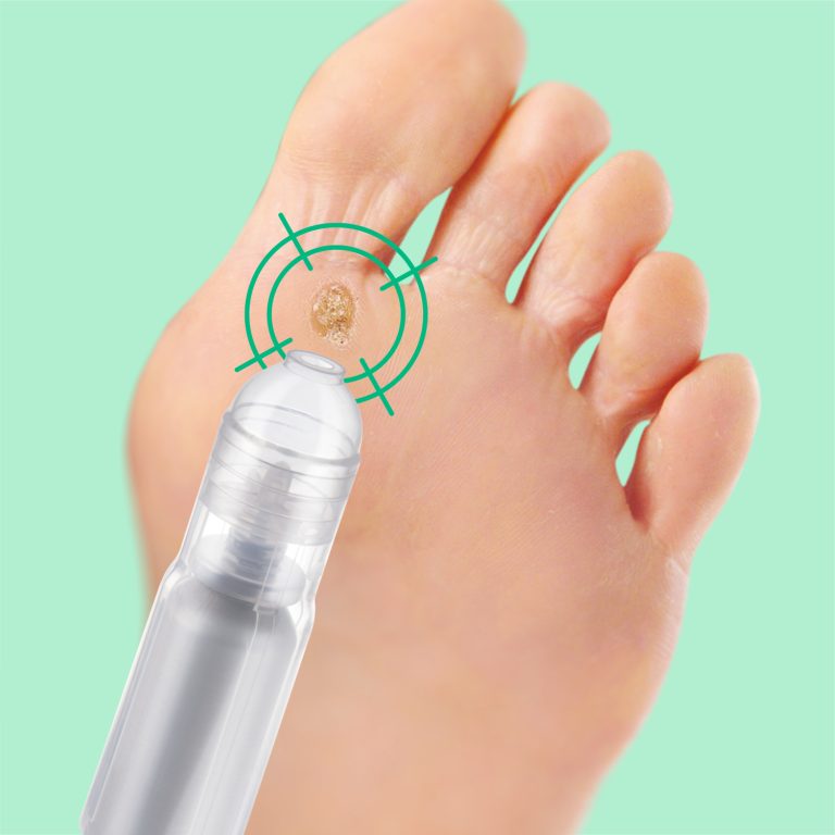 MICOBLOCK VERRUCHE CRYO Mani e piedi