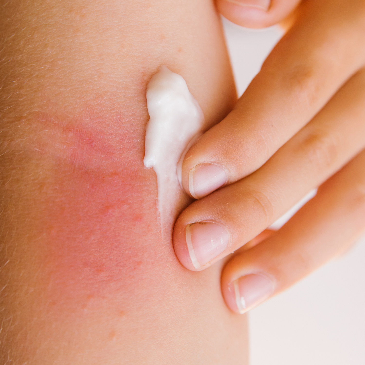 PRURITO  CREMA FLUIDA - immagine 2